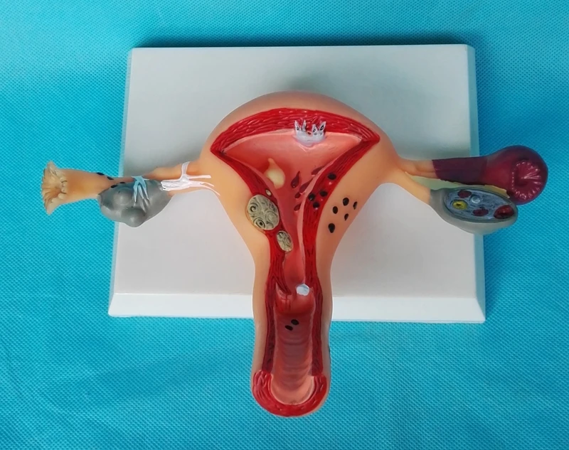 Модель объяснения Патологии женской матки Анатомическое Акушерство и гинекология Строение матки Патологическая модель матки